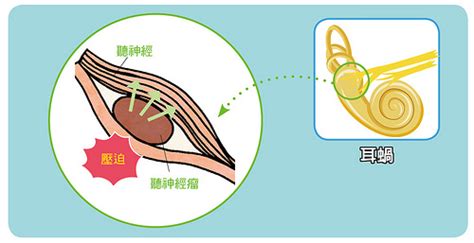 左耳一直有聲音|耳鳴原因有3種，一直耳鳴怎麼辦？舒緩耳鳴症狀醫師。